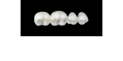 Cod.S2LOWER LEFT : 15x  posterior solid (not hollow) wax bridges, MEDIUM , (37-34) , with precarved occlusion to Cod.S2UPPER LEFT,and compatible to Cod.E2LOWER LEFT (hollow), (37-34)
